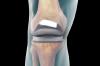 Photo for Medical Implants Market Competitive Dynamics & Global Outlook 2025