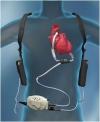 Photo for Cardiomyopathy Devices  Market Potential Growth, Share, Demand and Analysis of Key Players- Research Forecasts to 2025