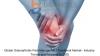 Photo for Global Osteoarthritic Pain Management 2018-2025 - Industry Trends, Market Size, Segments, Growth Prospects