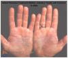 Photo for Global Psoriasis Treatment Market 2018-2025 – Market Estimate, Competitive Landscape, Industry Size