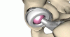 Photo for Hip Replacement Implants Market 2025: Industry Size Outlook, Increasing Trend Diversity, Analysis, Future Scope
