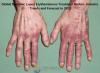 Photo for Global Systemic Lupus Erythematosus Treatment Market Growth till, 2018-2025