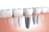 Photo for Global Titanium Dental Implants Market know the Market Driving Factors