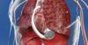 Photo for Cardiac Implants Market, By Devices, Application, End User - Global Industry Insights, Trends, Outlook, And Opportunity Analysis, 2018-2026
