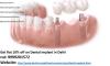 Photo for Get Dental Implant by a Best Implant Dentist in Delhi