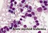 Photo for Acute Myeloid Leukemia Therapeutics Market Key Players & Growth Rate and Forecasts to 2023