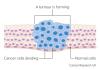 Photo for Tumor Cells