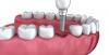 Photo for Tooth Regeneration Market, By Application, and Geography - Insights, Opportunity Analysis, and Industry Forecast till 2024