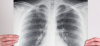 Photo for CHRONIC BRONCHITIS AND EMPHYSEMA (COPD) NAPLES FLORIDA