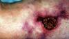 Photo for Calciphylaxis Treatment Market - Size, Share, Trends, and Forecast to 2026