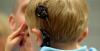 Photo for Binaural Cochlear Implant Market - Size, Share, Outlook, and Opportunity Analysis 2018 – 2026