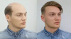 Photo for Best Hair Transplant in Chandigarh At Reasonable Cost