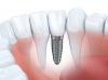Photo for 5 tips for porcelain veneers care