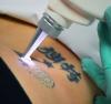 Photo for Permanent Laser Tattoo Removal in Dubai
