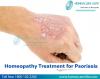 Photo for Effective Homeopathy Treatment For Psoriasis
