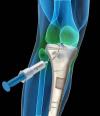 Photo for Bone Graft Substitutes Market – Global Industry Insights, Trends, Outlook, and Opportunity Analysis, 2018-2026
