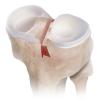 Photo for Collagen Meniscus Implant Market Revenue Growth Predicted by 2026