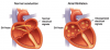 Photo for Atrial Fibrillation Market – Global Industry Insights, Trends, Outlook, and Opportunity Analysis, 2018–2026