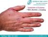 Photo for Cure Eczema Effectively With Homeopathy