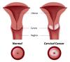 Photo for Cervical Dysplasia Diagnostic Market - by Diagnostic, and End Users - Global Industry Insights, Trends, Outlook and Opportunity Analysis 2018-2026