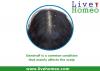 Photo for Get Rid Of Dandruff With Homeopathy