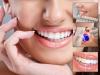 Photo for Dental Implants in Plainfield IL: Smile Freely