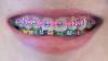 Photo for Dental Braces Market Demands and Growth Prediction, Outlook 2018-2026