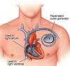 Photo for Cardiac Pacemaker Market Determined By Market Concentration Rate, New Entrants, Products, Services And Solutions 2026