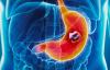 Photo for Gastric Cancer Therapeutics Market Predicted to Grow at a Moderate Pace Through 2026