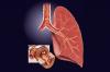 Photo for Bronchitis Market Overview, Trends and Market Growth Analysis Research Report 2023