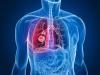 Photo for Malignant Ascites Treatment Market - Size, Share, Outlook and Opportunity Analysis 2018-2026