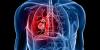 Photo for Liver Cancer Therapeutics Market - Global Industry Insights, Trends, Outlook, and Opportunity Analysis 2018-2026