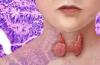 Photo for Thyroid Cancer Drugs Market moving toward 2026 With New Procedures