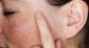 Photo for Hereditary Angioedema Market: Analysis of Rising Business Opportunities with Prominent Investment Ratio by 2026