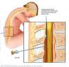 Photo for Lumbar Puncture Cost in India - Credihealth