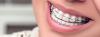 Photo for Orthodontic Supplies Market, by Product type, Brackets Type, Material - Global Industry Insights, Trends, Outlook, and Opportunity Analysis, 2018–2026