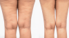 Photo for Cellulite Treatment Market by Manufacturers, Regions, Forecast to 2026