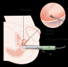Photo for Global Prostate Biopsy Devices Market Analysis- Application, Type, Voltage, End-User, Category, Global Trends and Forecast To 2024