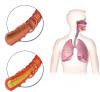 Photo for The Respiratory Diseases Drugs Market To Improve Its Performance
