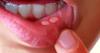 Photo for Global Mouth Ulcer Treatment Drug Market Insight 2019 - Technology and Forecast Research Till 2025