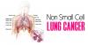 Photo for Non-Small Cell Lung Cancer Market – Industry Insights, Size, Share and Analysis, 2018-2026