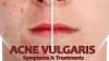 Photo for Acne Vulgaris Treatment Market Analysis and In-depth Research to See Incredible Growth