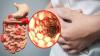 Photo for Crohn's Disease Treatment Market to Surpass US$ 10 Billion by 2026