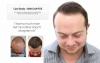 Photo for Hair Transplant Cost For Your Scalp