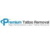 Photo for Laser Tattoo Removal in Houston Texas