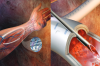 Photo for Vascular Grafts Market Global Industry Insights, Trends, Outlook and Opportunity Analysis, 2018-2026