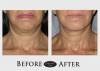 Photo for Non-Surgical Skin Tightening Market Seeking Growth from Emerging Markets, Study Drivers, and Forecast 2026