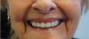 Photo for Permanent Soft Denture Liners Airdrie
