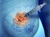 Photo for Global Breast Lesion Localization Methods Market Anlysis with Inputs form Industry Experts 2018 to 2026