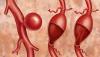 Photo for Endovascular Aneurysm Repair (EVAR) Market Set for Rapid Growth and Trend, by 2026